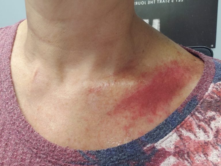 #18 RADIATION PROCESS & SIDE EFFECTS